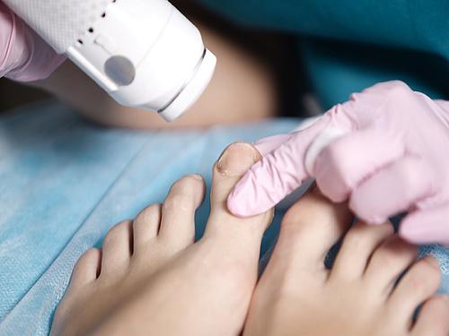 Come si contagiano funghi unghie dei piedi