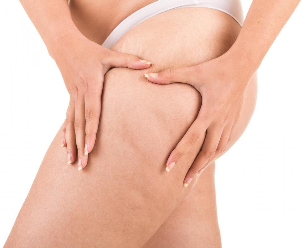 cellulite