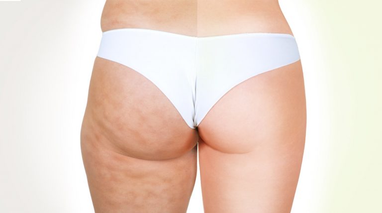 Come ridurre ritenzione idrica