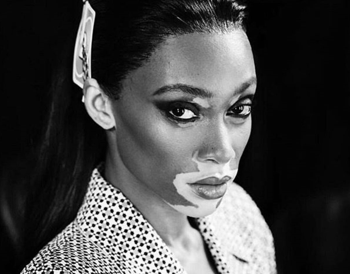 winnie harlow