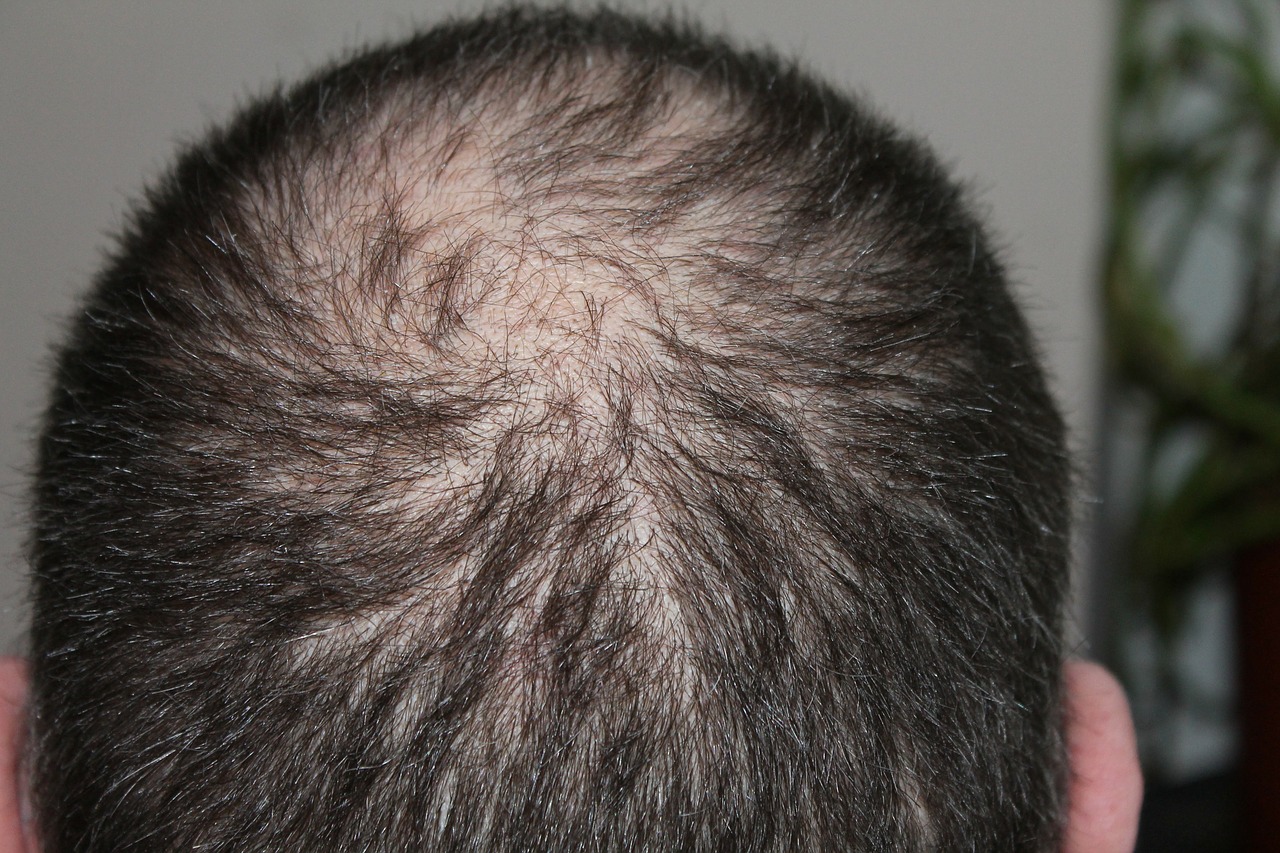 Capelli diradati: le cause e i rimedi naturali