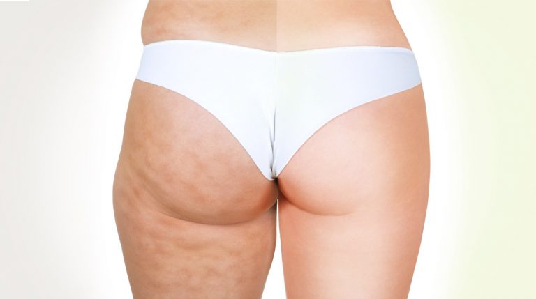 come eliminare la cellulite