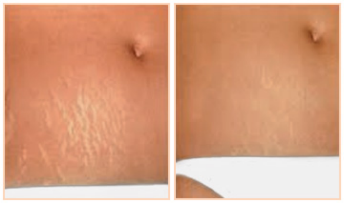 crema per smagliature