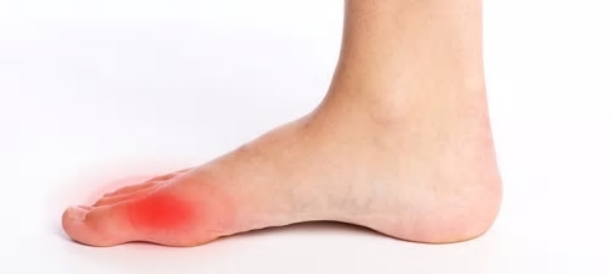 plantare alluce valgo