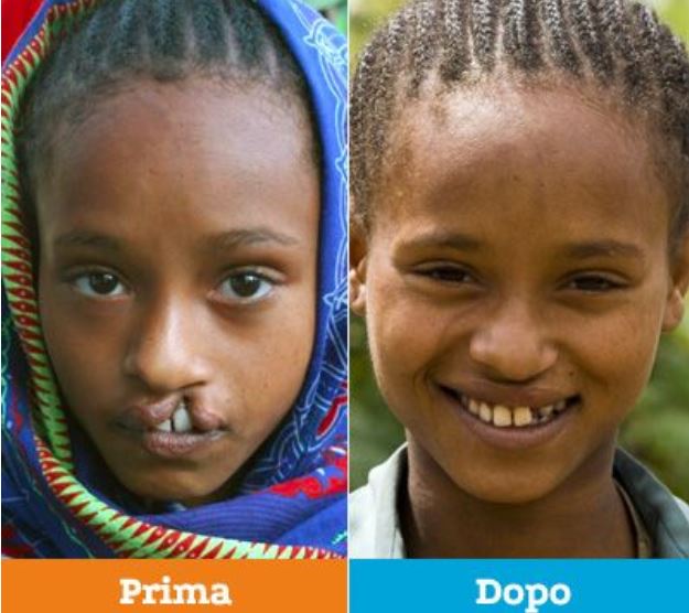 labbro leporino prima e dopo