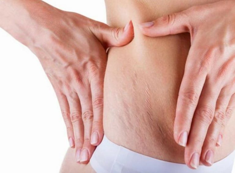 Le migliori creme contro le smagliature