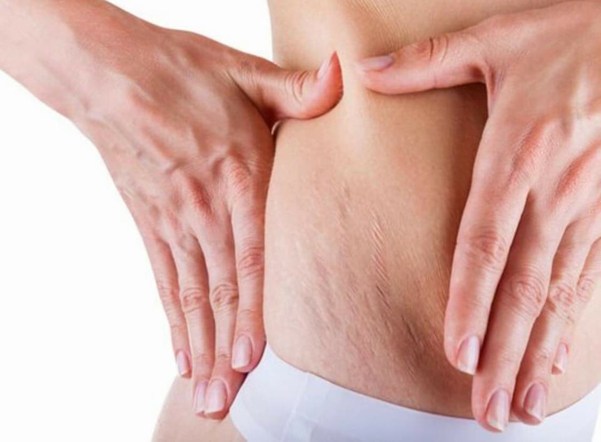 Le migliori creme contro le smagliature