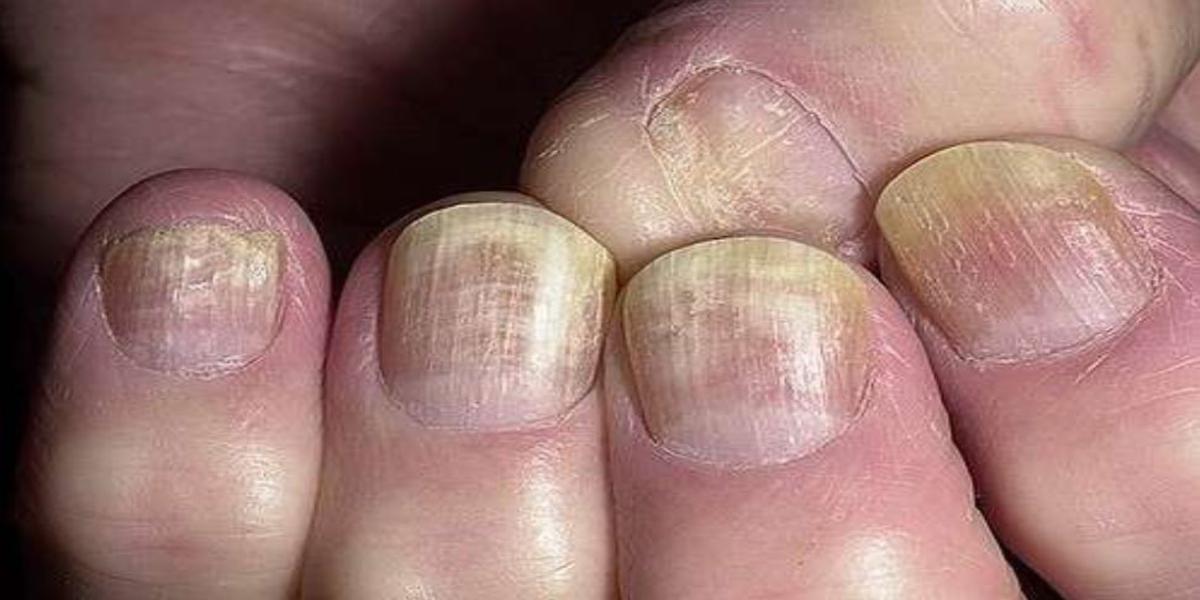 onicomicosi come curarla