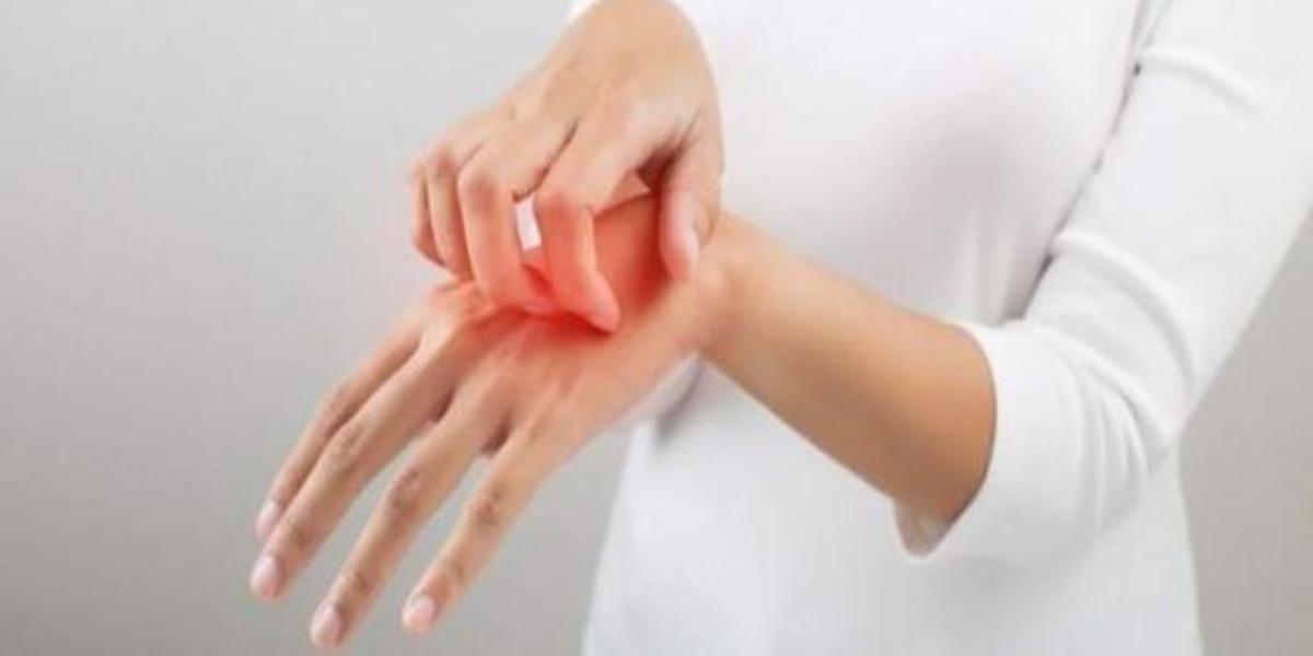 punture di zanzara rimedi