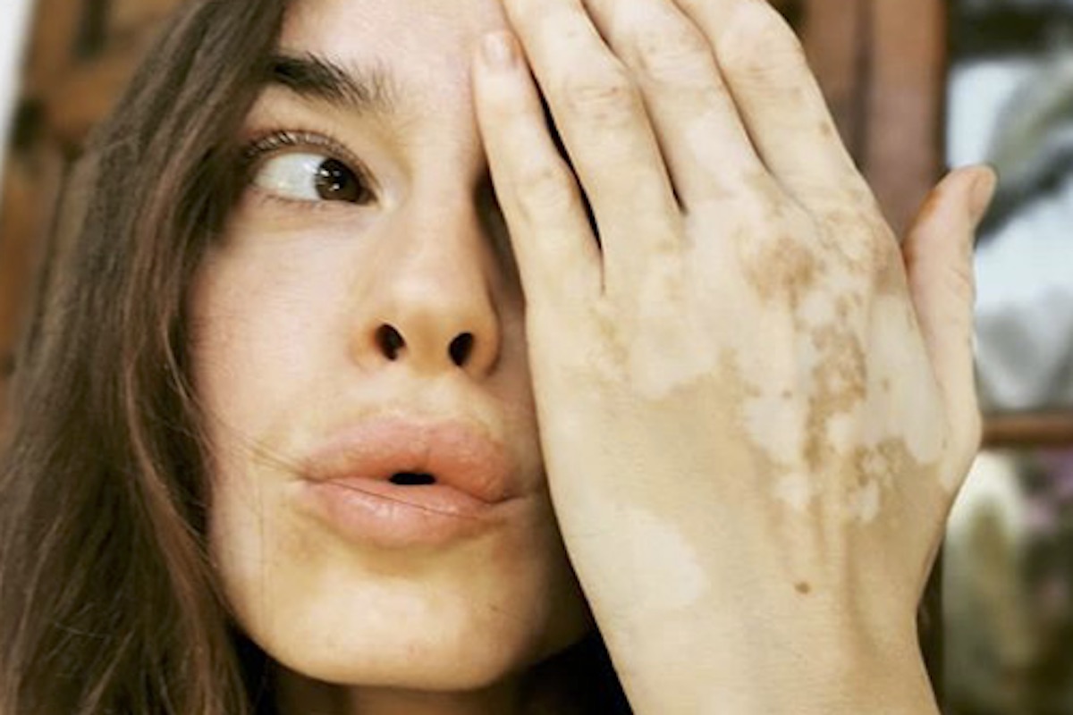 KasiaSmutniakfiltrovitiligine