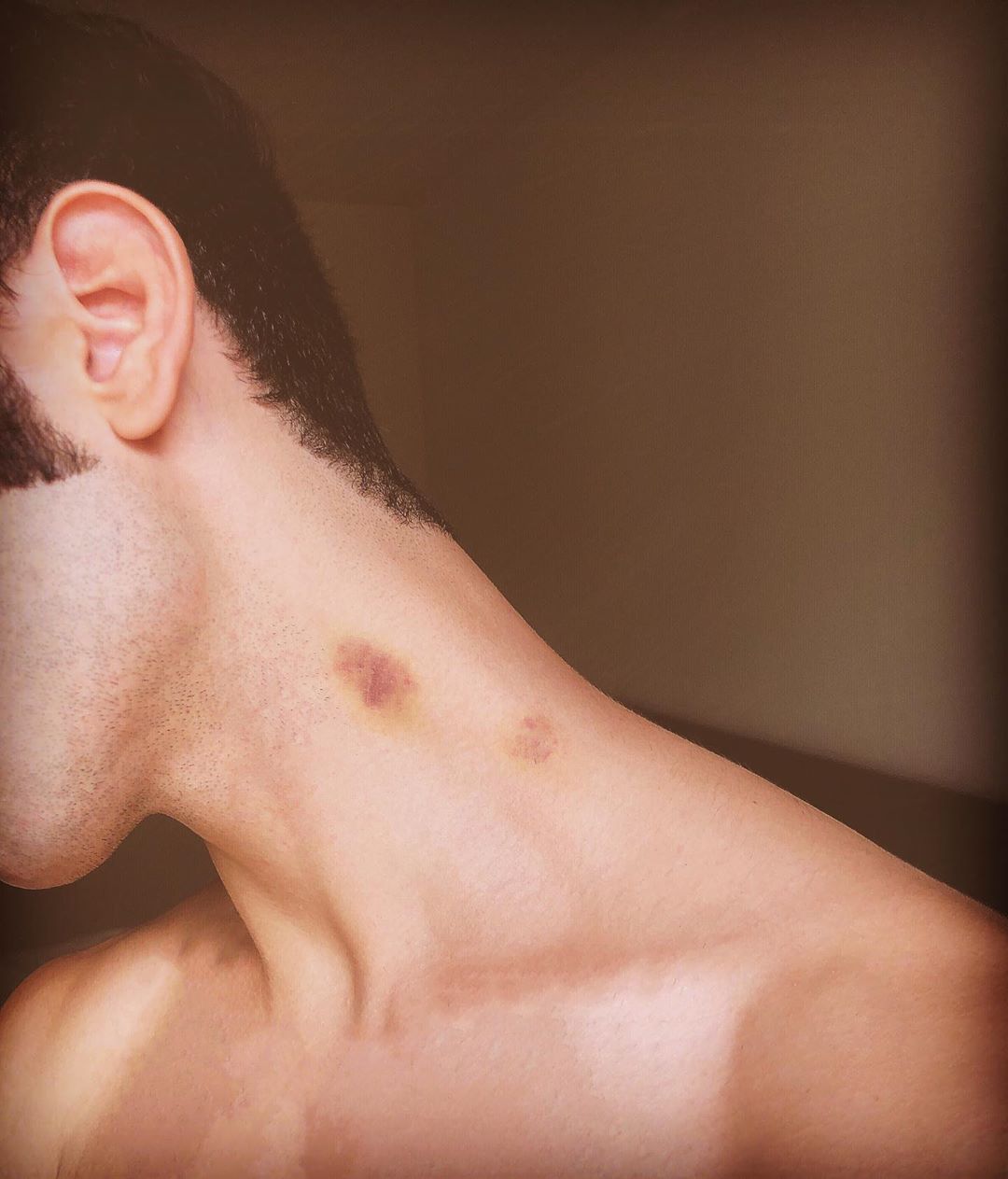 succhiotto sul collo