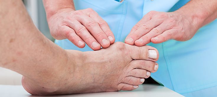 Alluce valgo cause sintomi