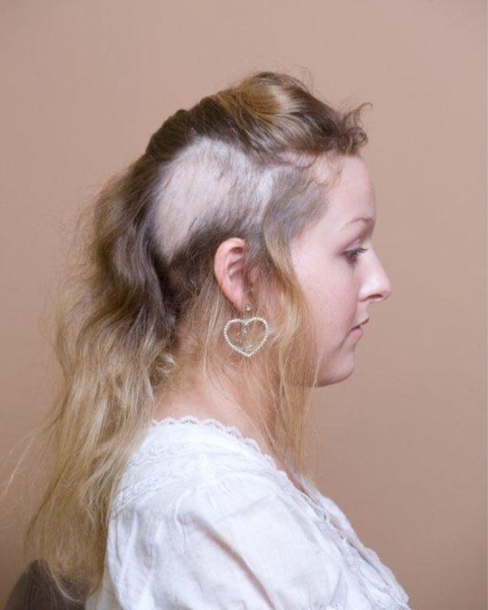 tricotillomania