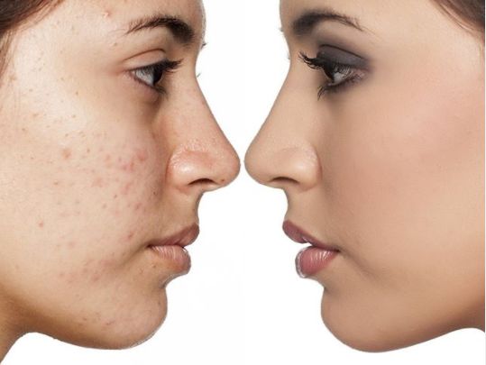 microneedling viso cosa e