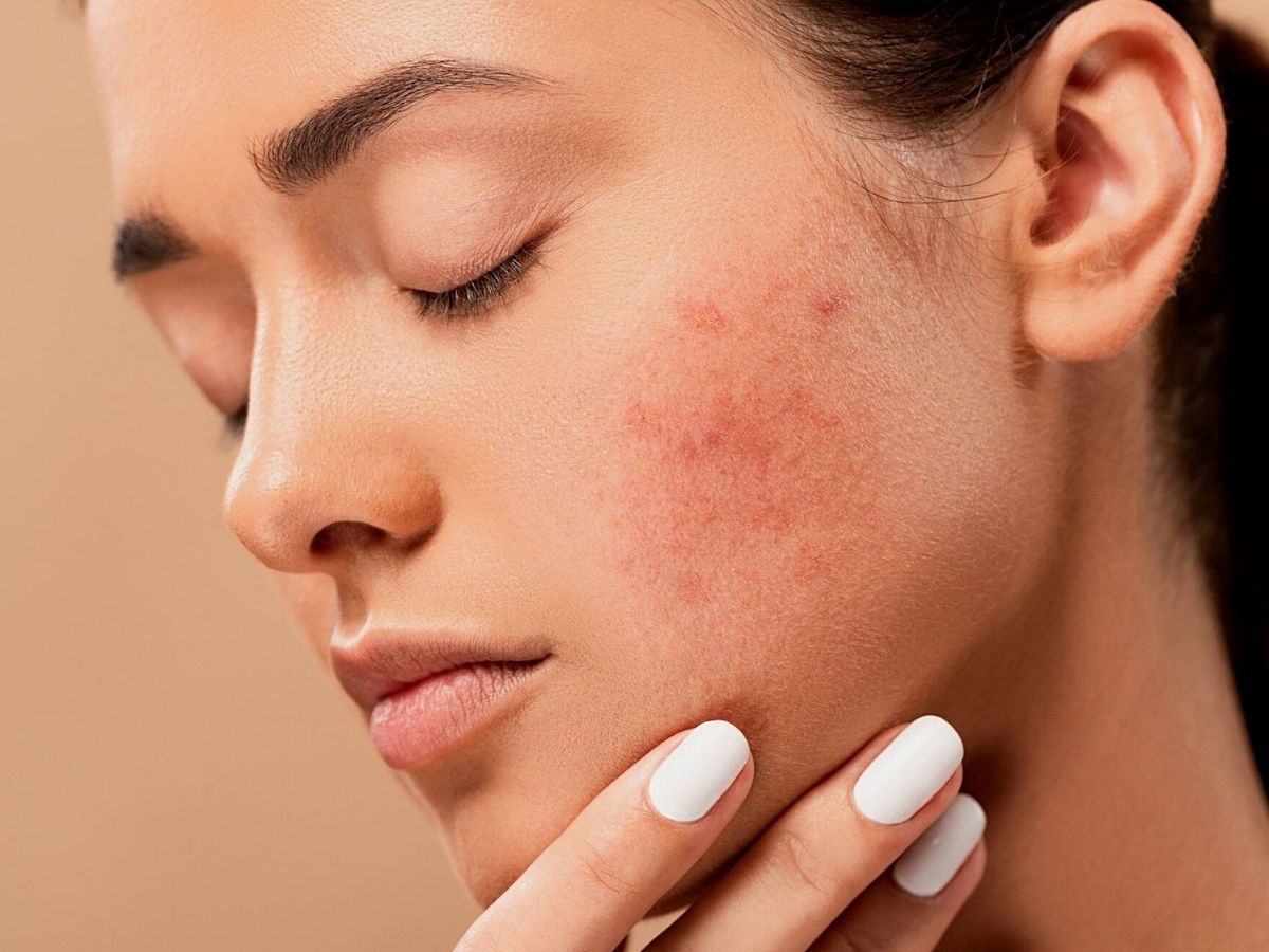 Come combattere l'acne sul viso