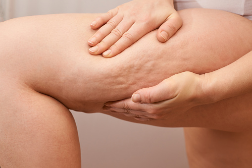 cellulite e attivit&agrave; fisica gli esercizi da fare