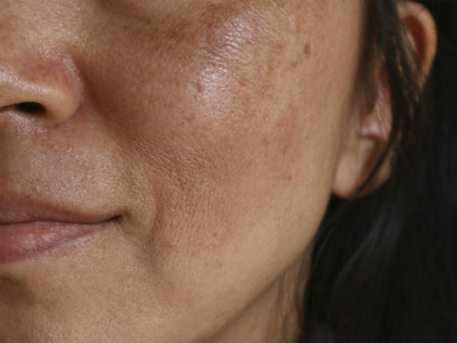 melasma