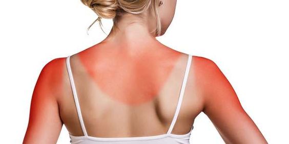 eritema come prevenire