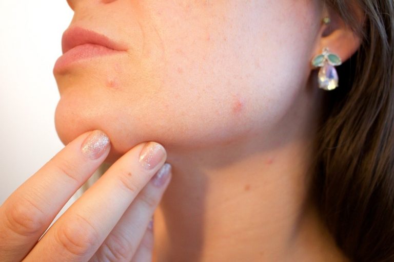 acne in età adulta rimedi