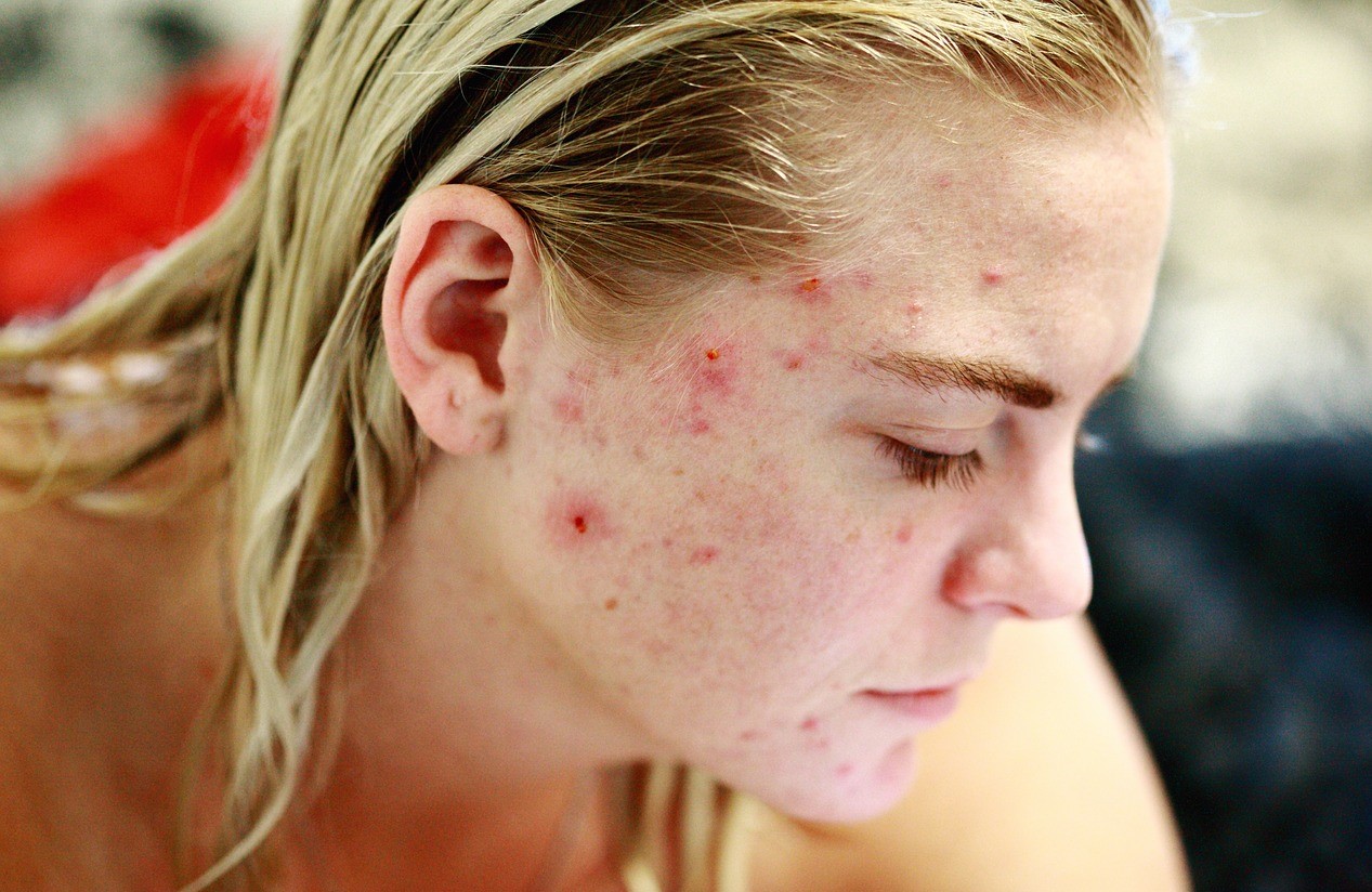 acne in et&agrave; adulta rimedi
