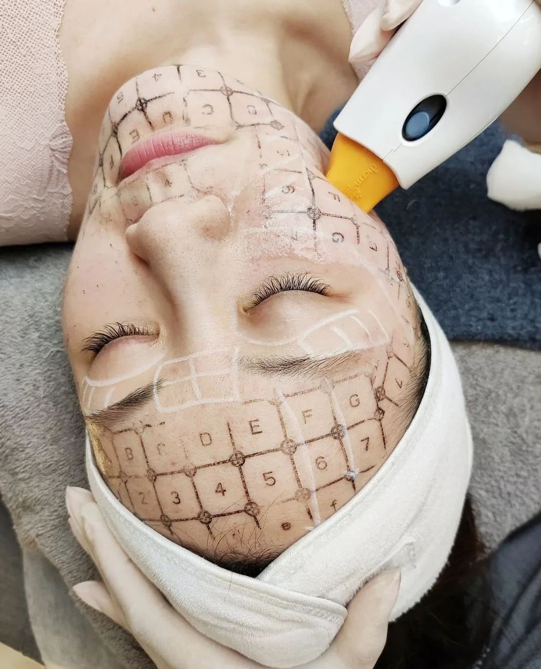 thermage cos'&egrave;