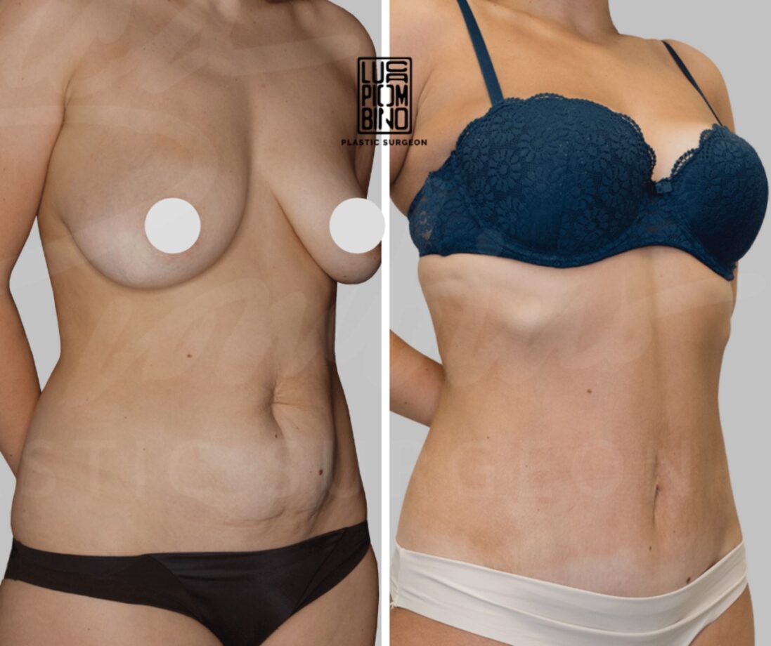 Addominoplastica: pancia piatta e tonica