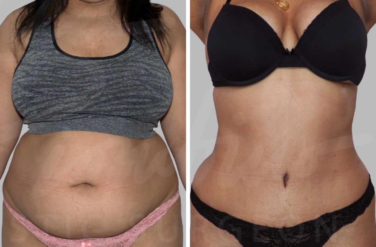 pancia piatta addominoplastica