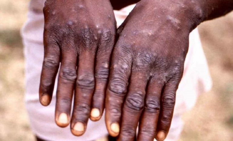 Arrivano le indicazioni dell'Oms sul Monkeypox