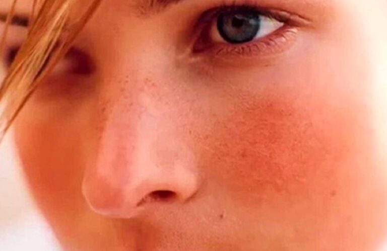 couperose sul viso