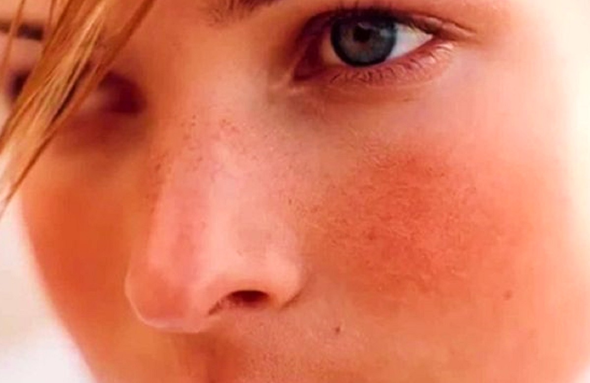 couperose sul viso