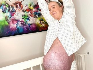 Le ventre surprenant d'une femme qui a donné naissance à des triplés