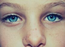 how to remove freckles