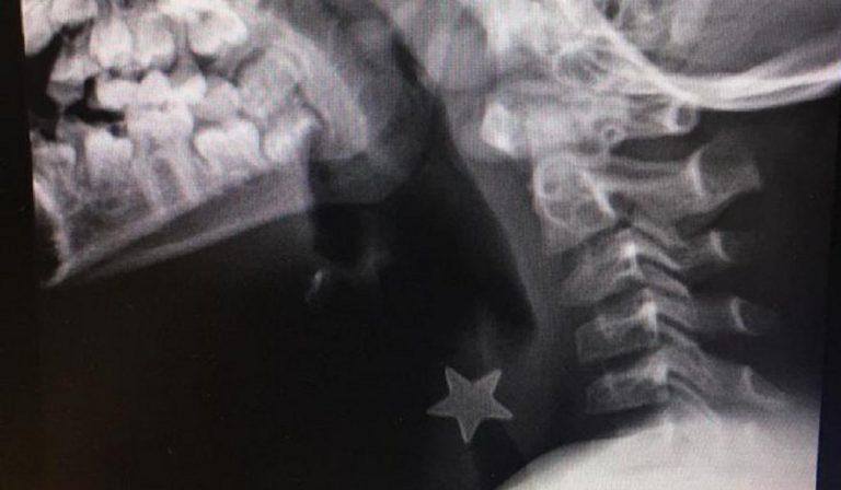 Bimbo inala pezzo di metallo, operato d’urgenza al Niguarda