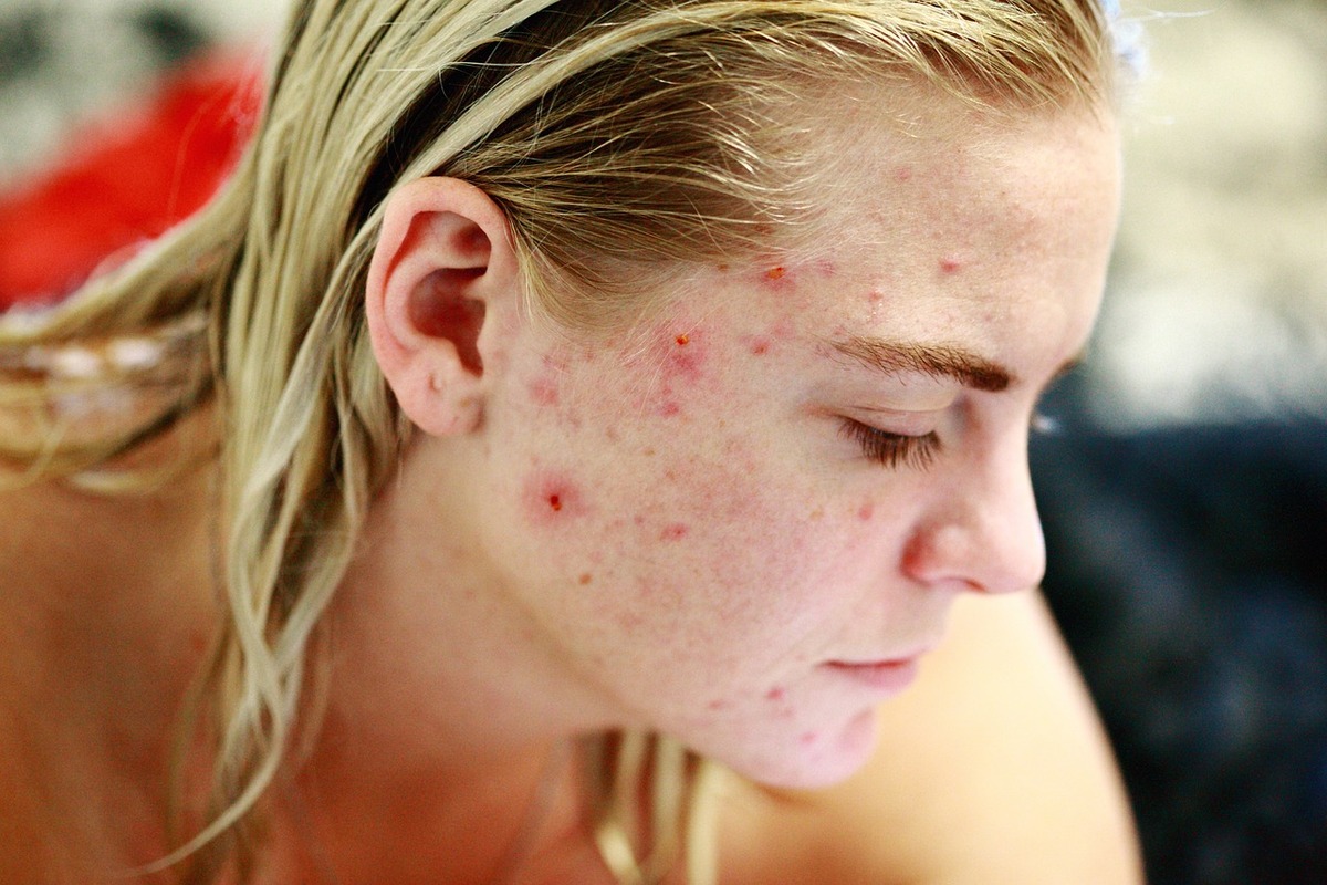 Acne nell’età adulta: perché non è solo un problema da adolescenti