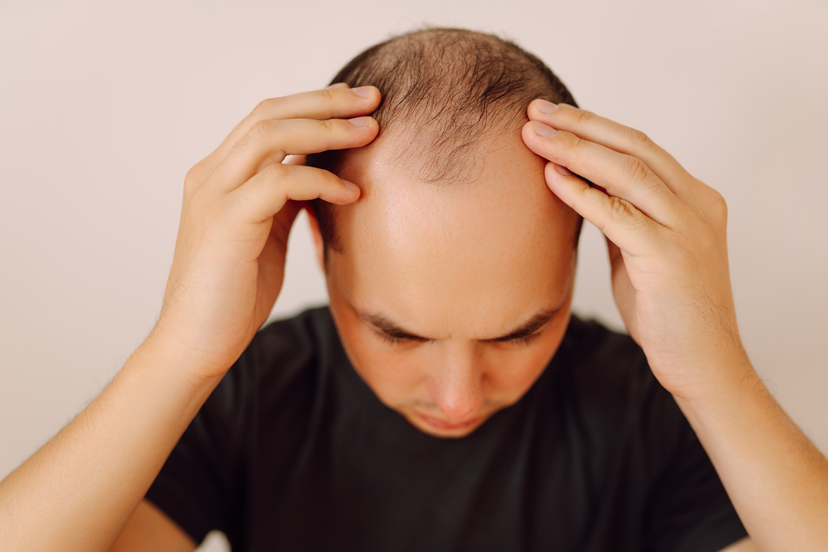 Alopecia androgenetica: nel 2025 come agire in modo completo