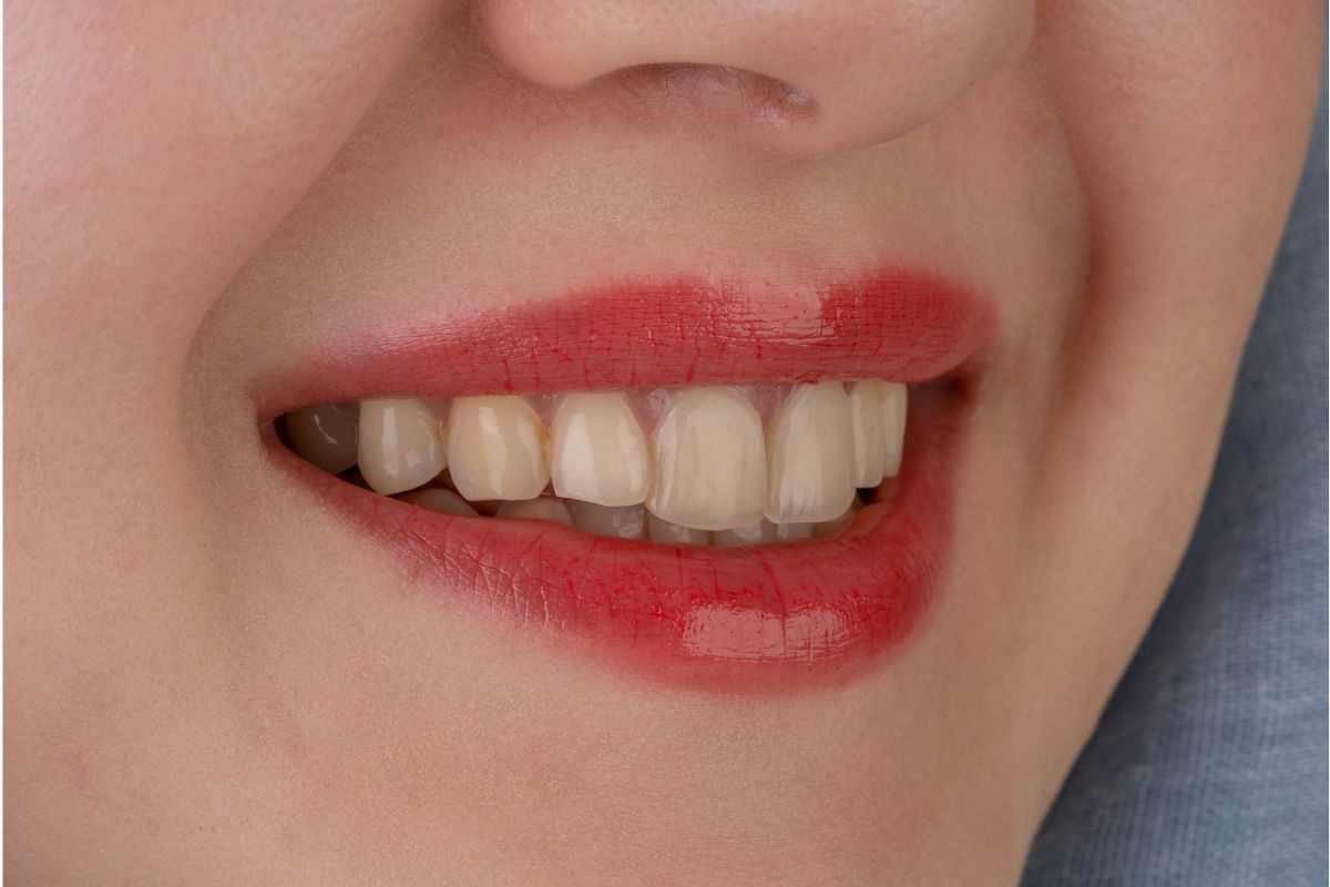 Impianto dentale: cosa sapere prima di valutare questa soluzione con il dentista