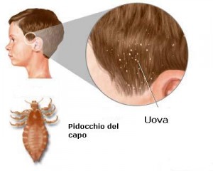 Pidocchi_uova Pidocchi uova 300x240