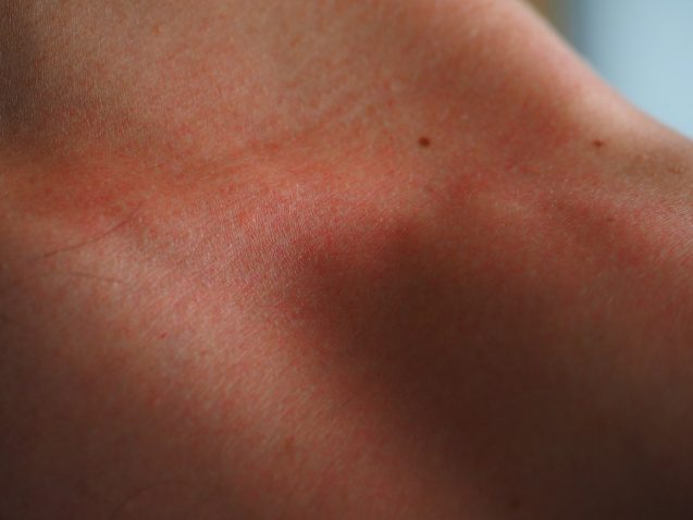 Usi della crema Elocon. A cosa serve e indicazioni