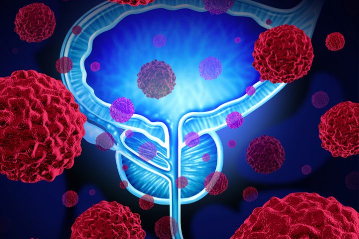 Come abbassare il Psa nel sangue: rimedio efficace