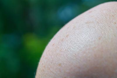 Cos'&egrave; il melanoma? Sintomi, prevenzione e successi dell'immunoterapia