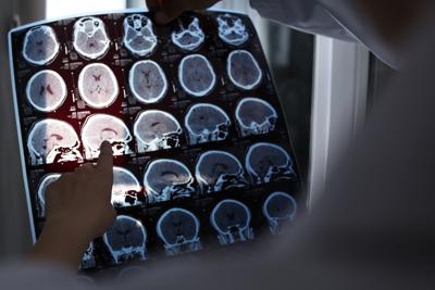 Alzheimer, prime linee guida europee contro labirinto diagnosi