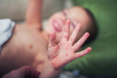 Morbillo: Ecdc, 7 morti e casi saliranno ancora, vaccinazioni insufficienti