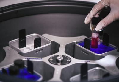 Hiv eliminato da cellule infette con editing genetico: lo studio