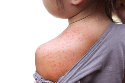 Sanità: boom morbillo e pertosse in Ue, Rezza 'super contagiose, rischiano adulti'
