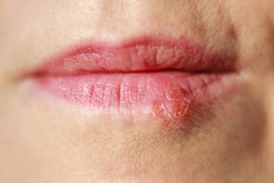 Terapia genica contro herpes labbra, con cura sperimentale -90% virus