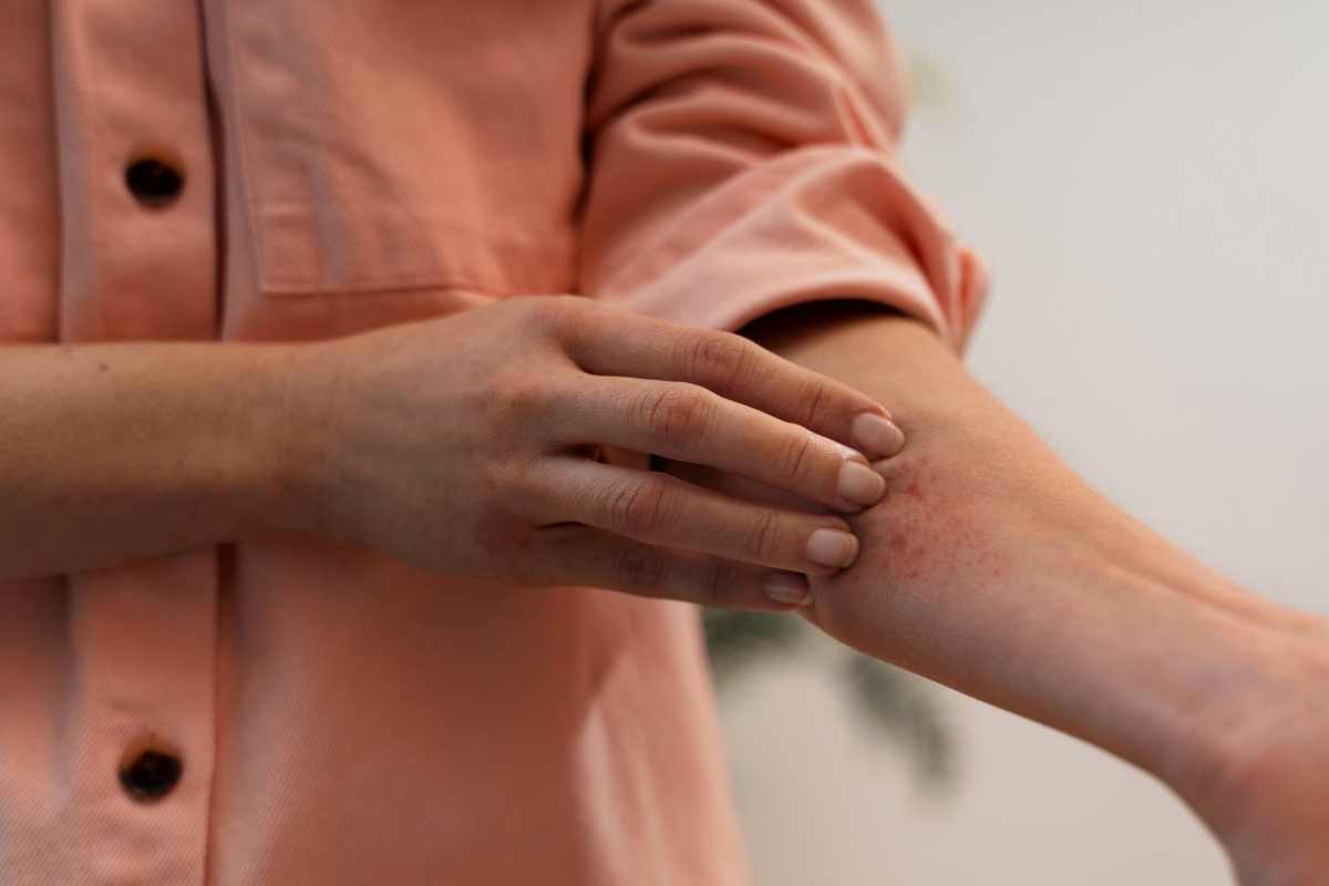 Come riconoscere la dermatite atopica: primi segnali, sintomi, campanelli d’allarme