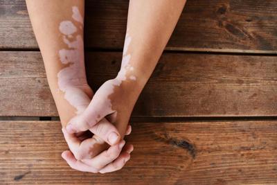 Salute, dermatologo Paro Vidolin: "Per vitiligine dopo 40 anni abbiamo un farmaco"