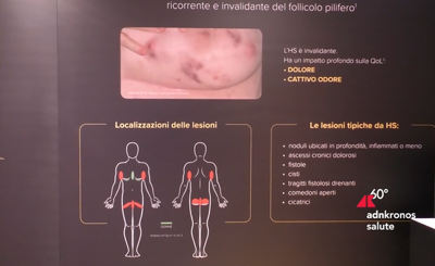Idrosadenite suppurativa, l&rsquo;esperto: "Pi&ugrave; attenzione a qualit&agrave; della vita"
