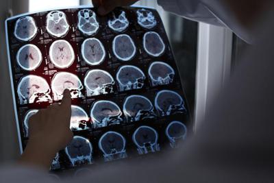 Alzheimer, via libera negli Usa a nuova terapia