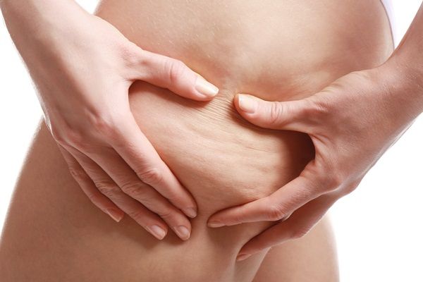 Ritenzione idrica: cause e rimedi naturali